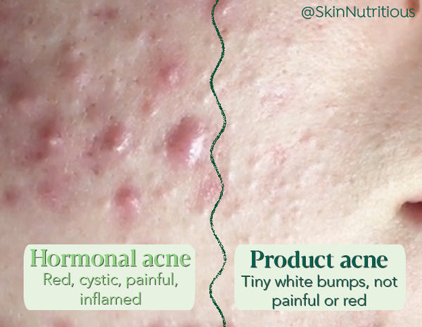 Acne Safe Checker: Uncover Pore-Clogging Ingredients Easily!