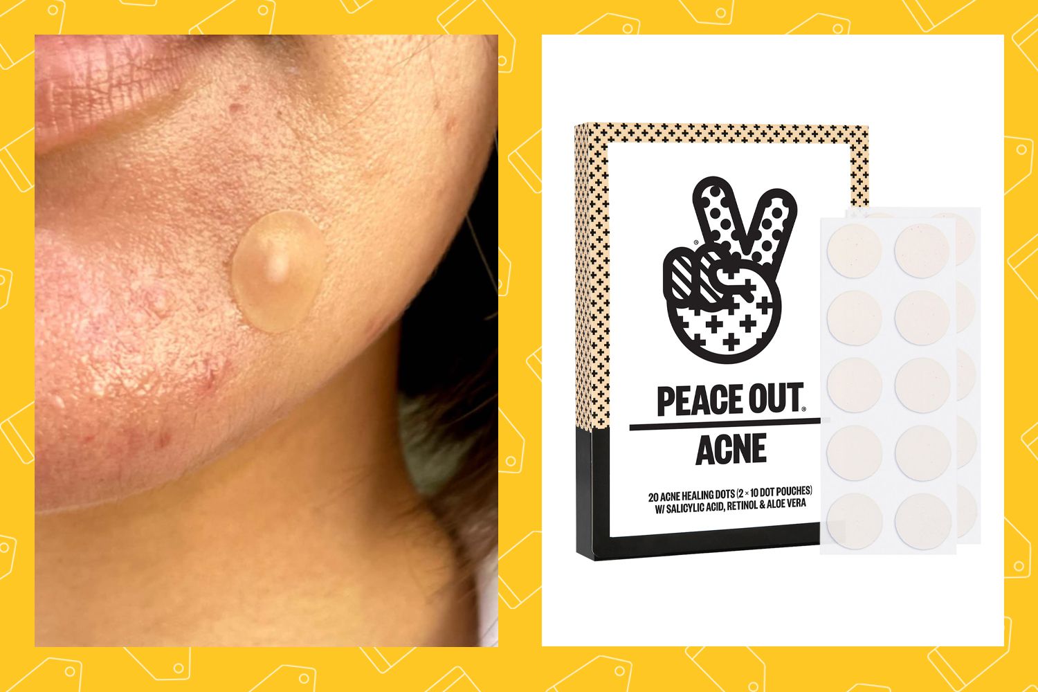 Best Acne Patch