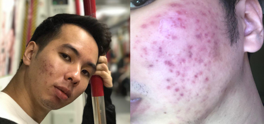 Best Acne Scar Treatment Singapore