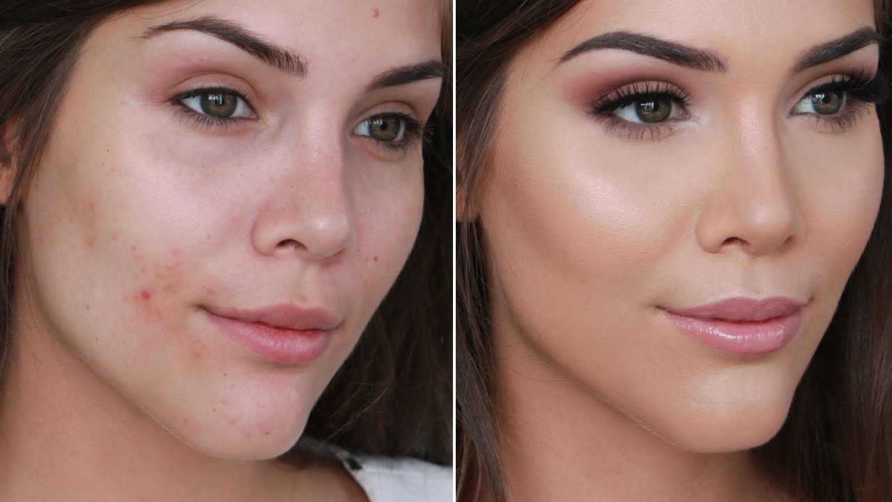 Best Way to Cover Acne With Makeup