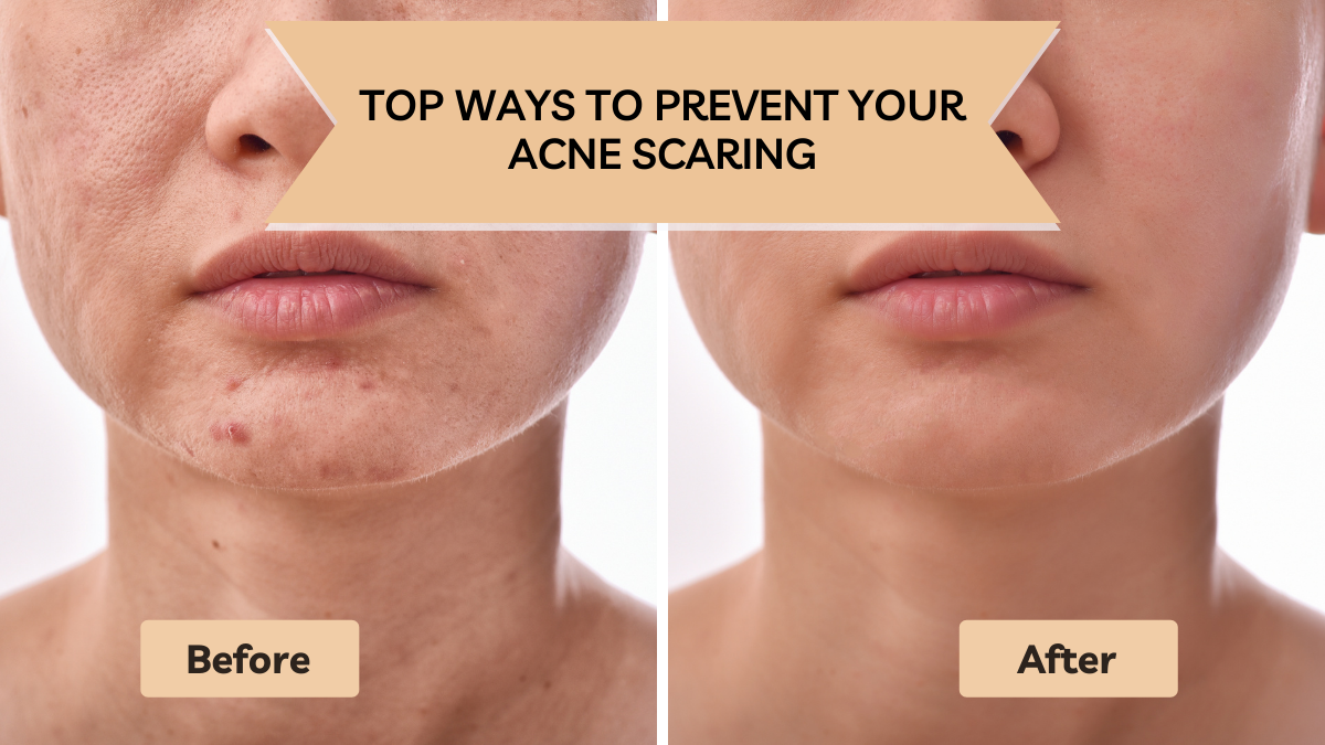 Best Way to Reduce Acne
