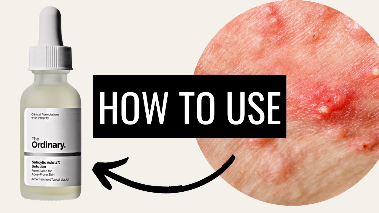 Best Way to Use Salicylic Acid for Acne