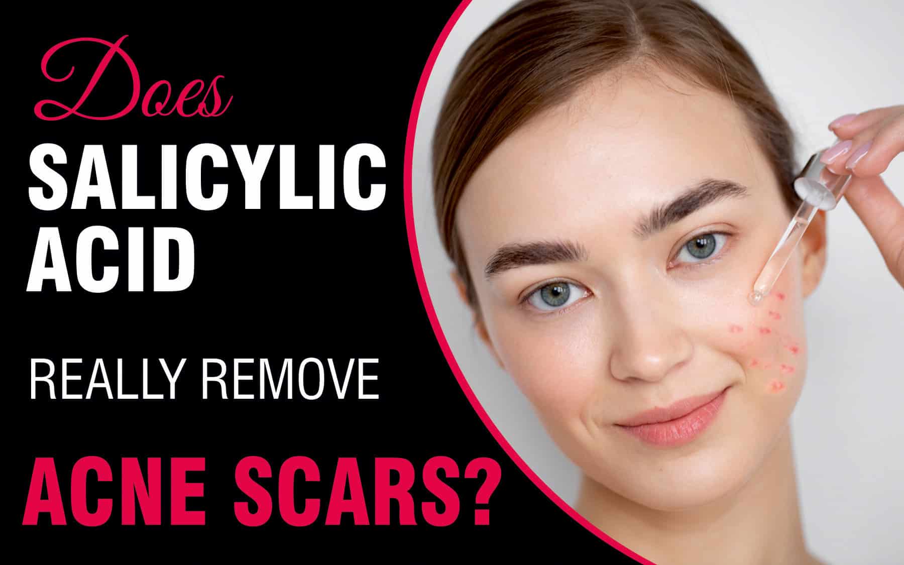 Does Glycolic Acid Help With Acne? Unveiling the Truth!