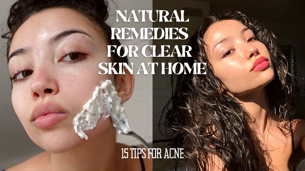 How to Cure Acne Naturally in 3 Days: Quick Clear Skin Tips