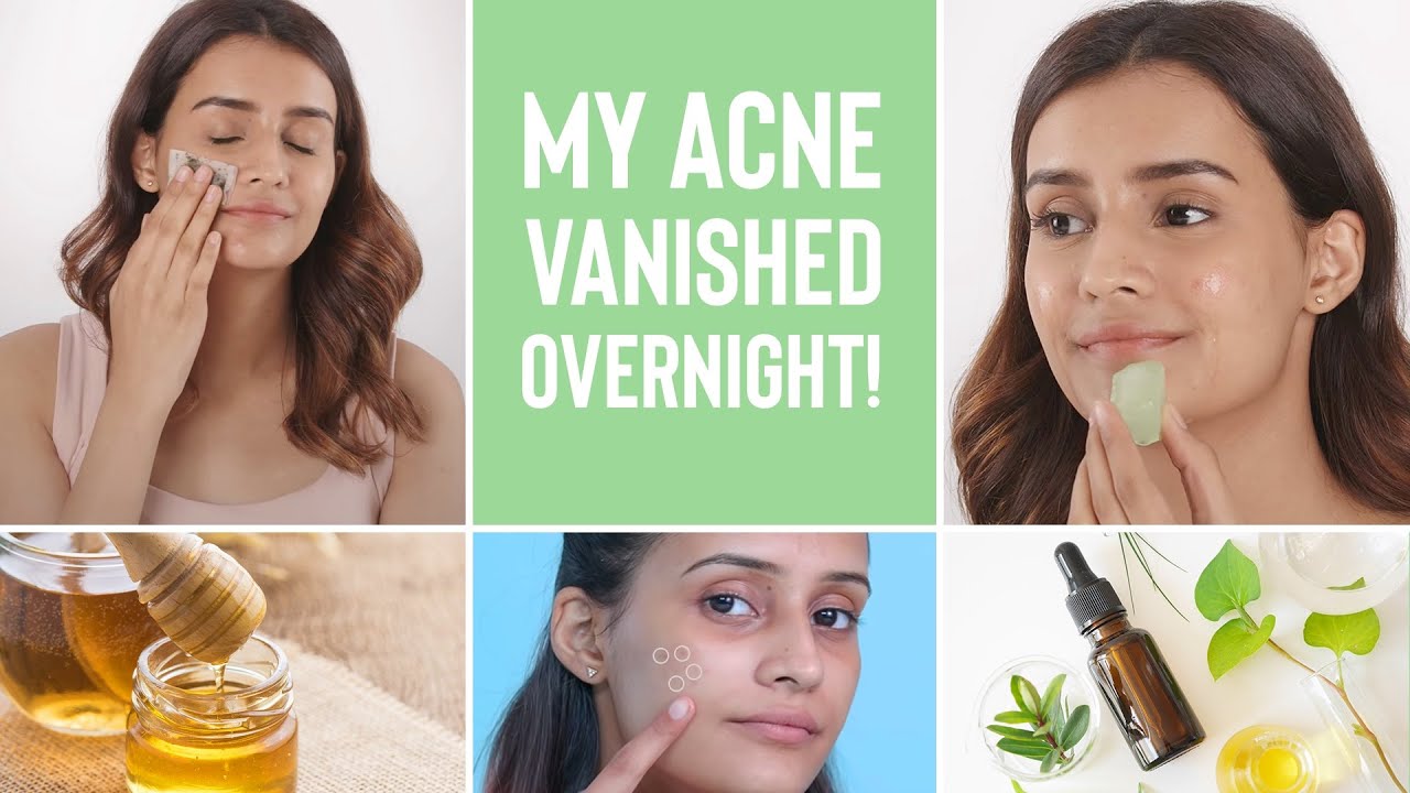 How to Improve Acne Overnight