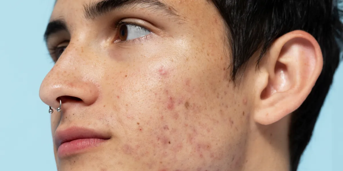 When is the Best Time to Take Acne